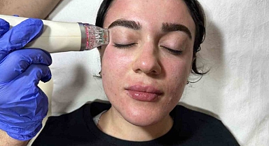 Güzelliğin anahtarı ’altın iğne’ tedavisinde
